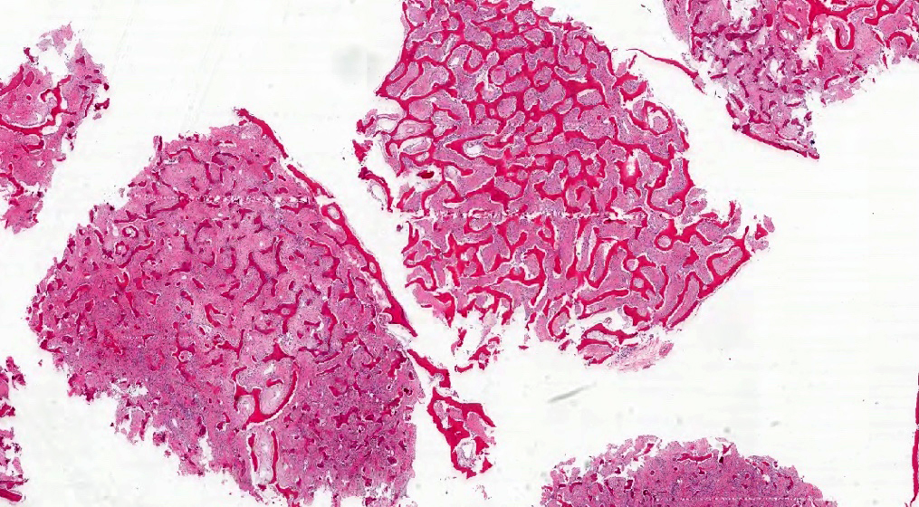 polyostotic fibrous dysplasia histology