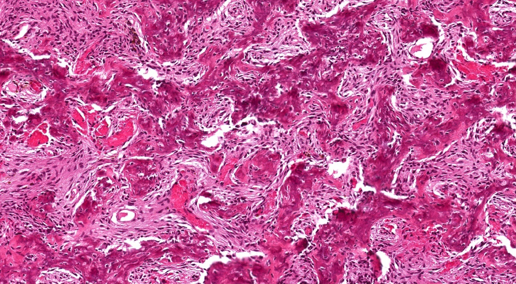 Pathology Outlines Juvenile Trabecular Ossifying Fibroma And