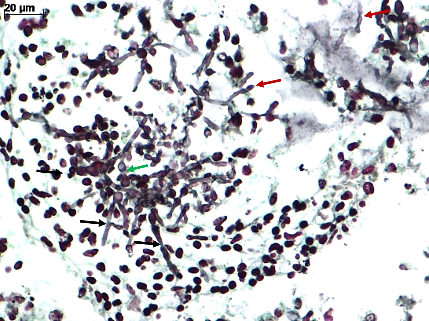 Pathology Outlines Candida Auris