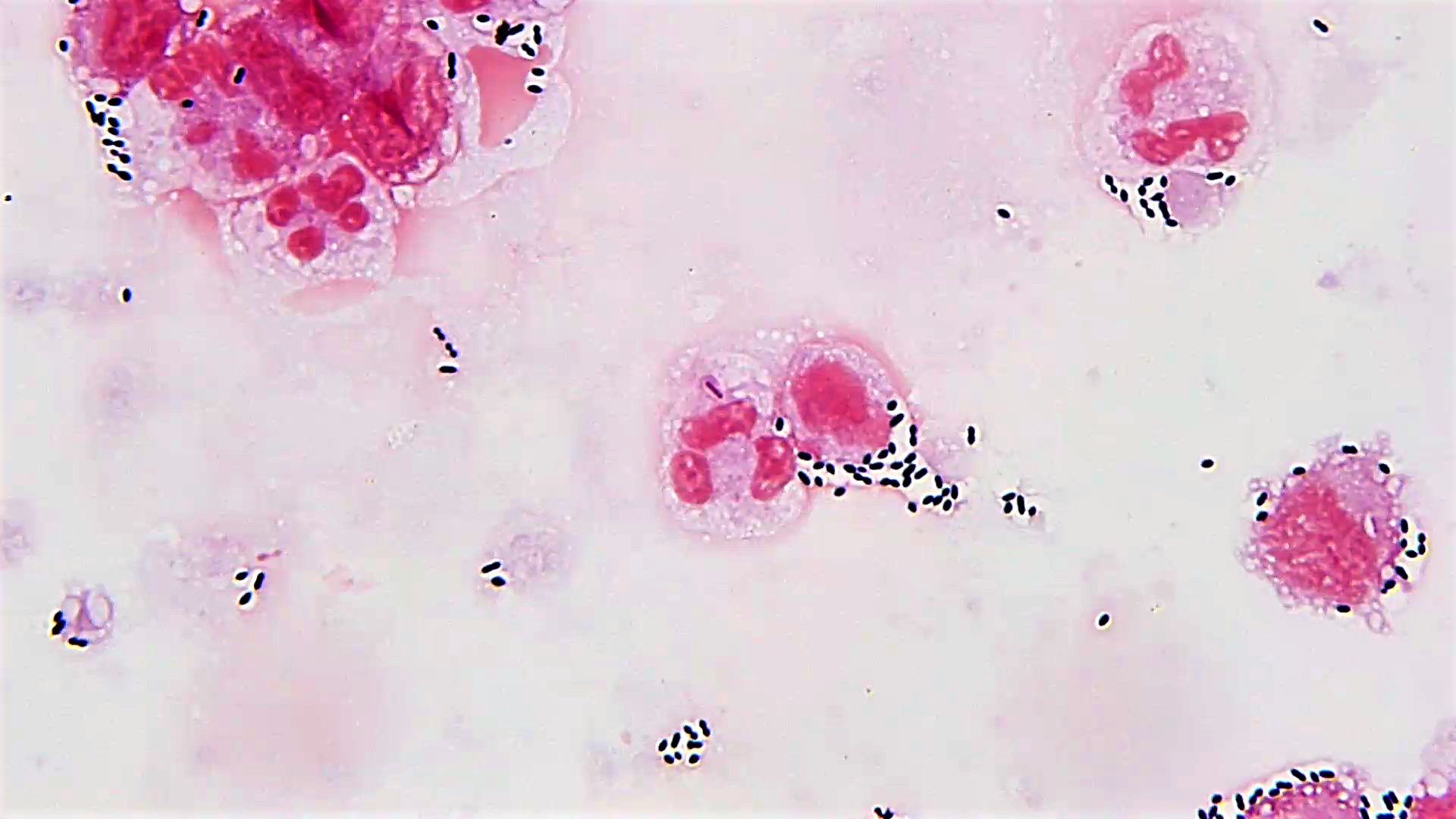 streptococcus pneumoniae gram stain csf