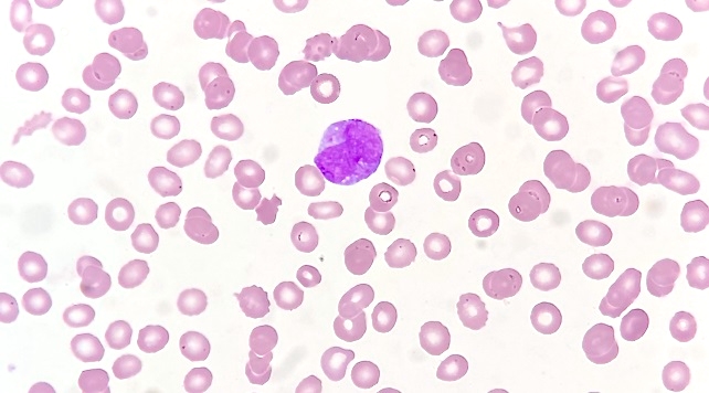 Pathology Outlines - PML::RARA