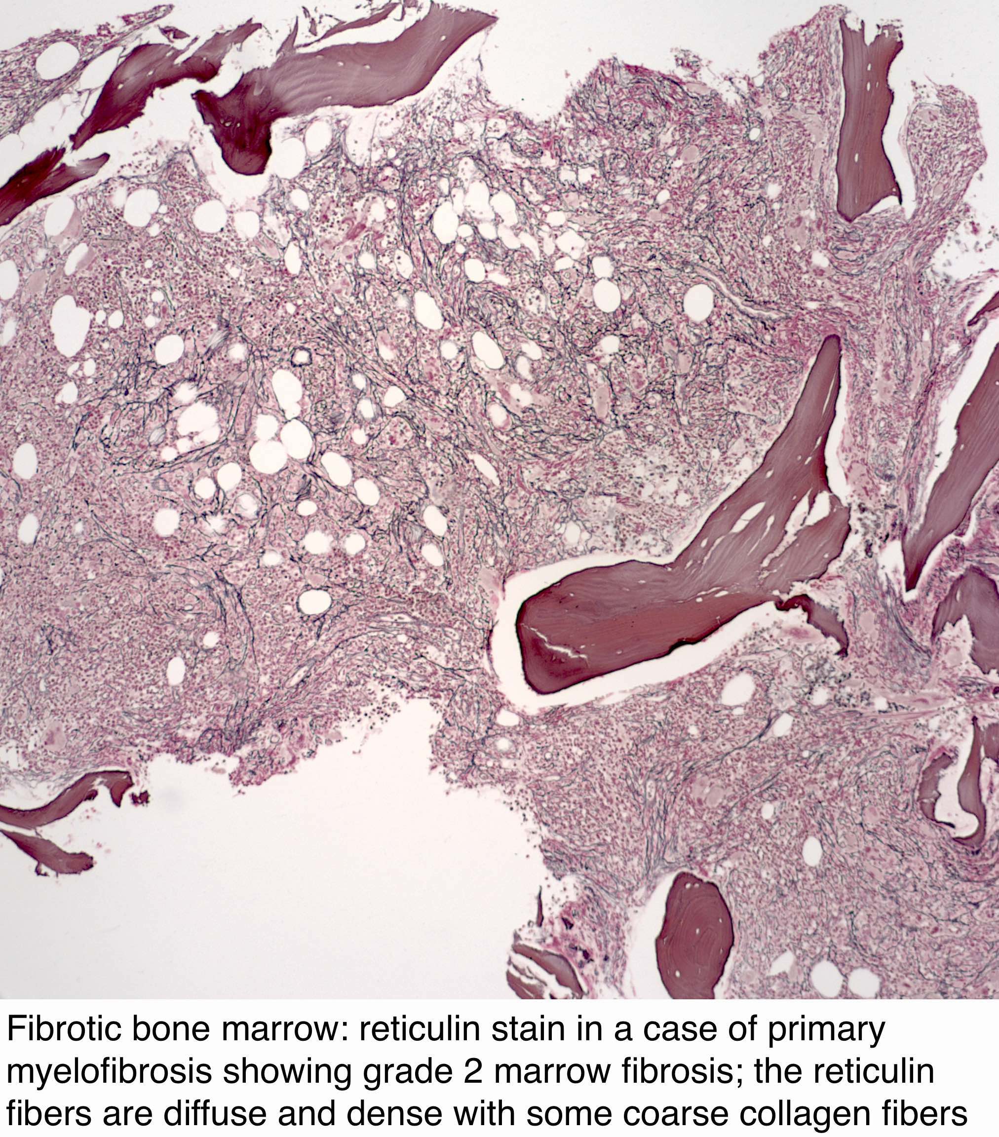 Pathology Outlines Primary Myelofibrosis