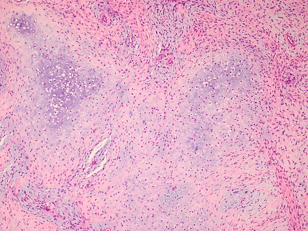 Pathology Outlines - Nasal chondromesenchymal hamartoma