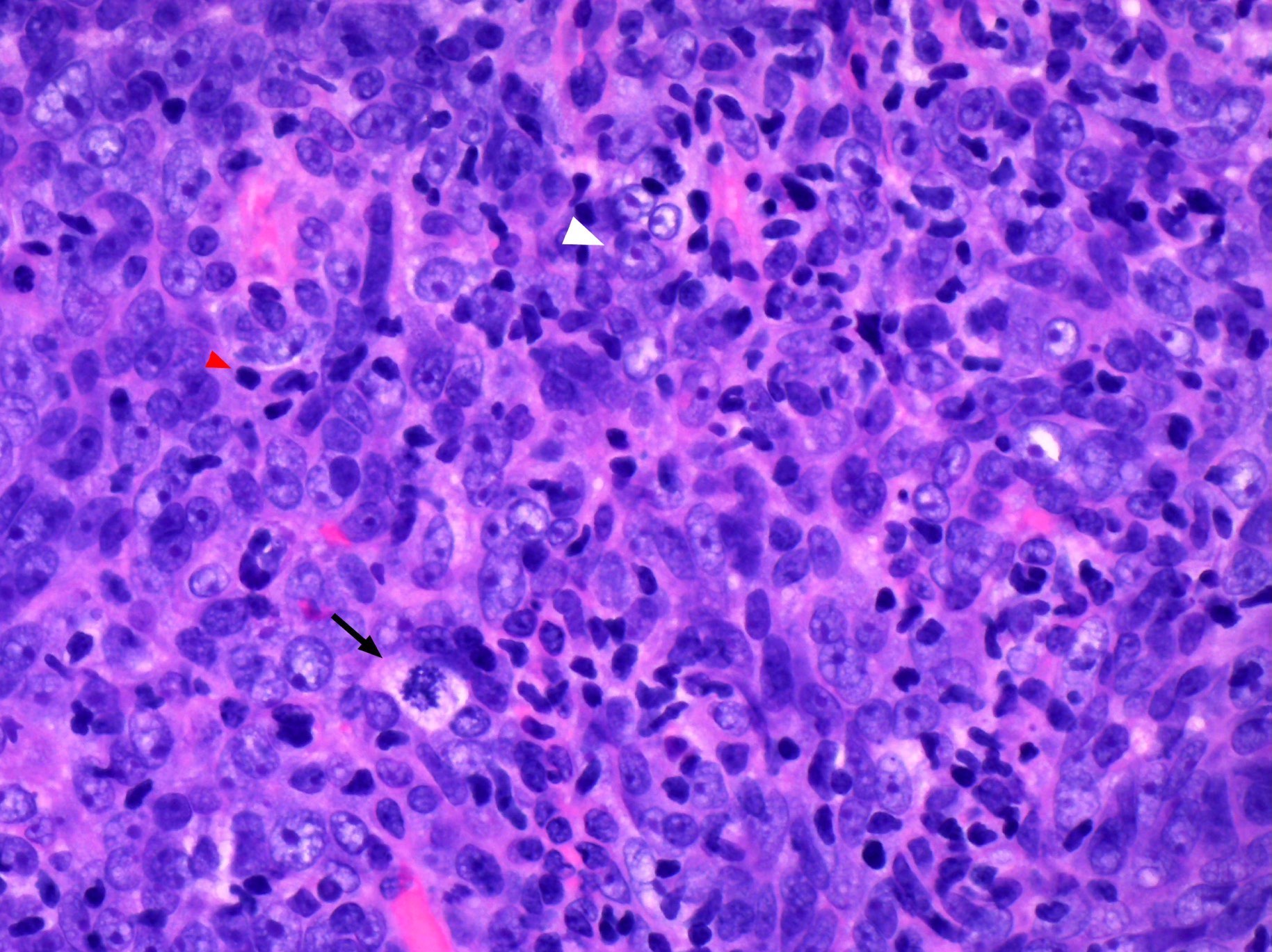 Nasopharyngeal Carcinoma Histology