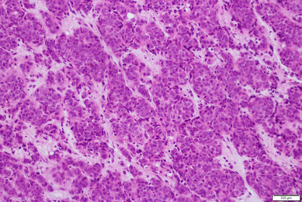 Undifferentiated Nasopharyngeal Carcinoma