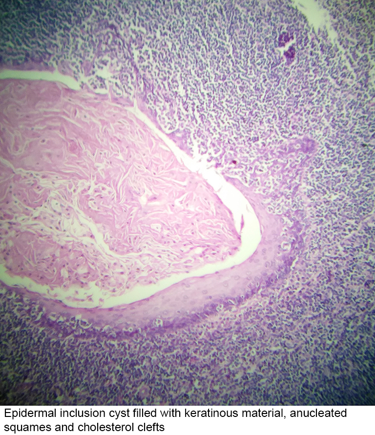 Inclusion Cyst Histology 8918