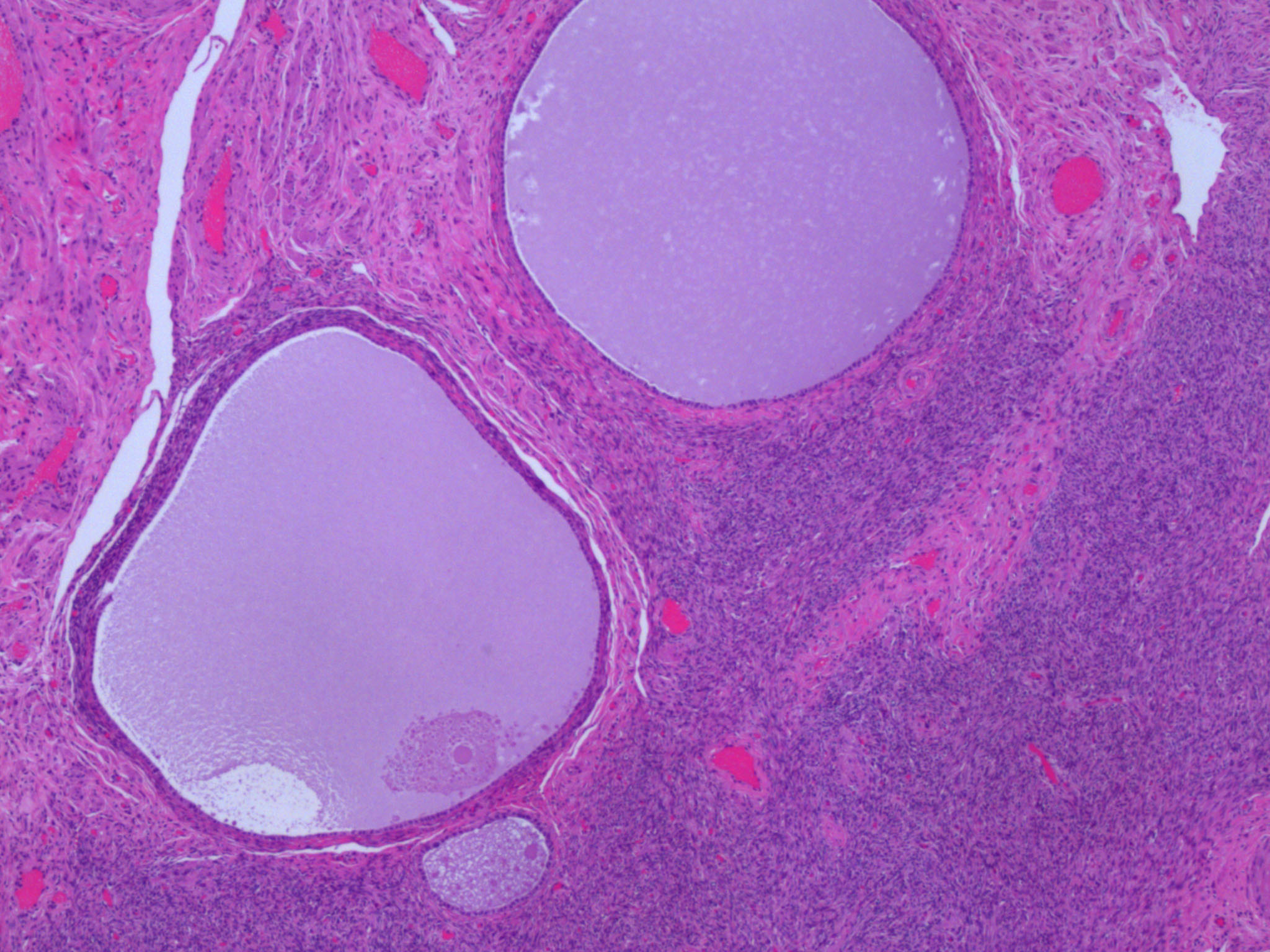 Epithelial Inclusion Cysts Of Skin Hot Sex Picture