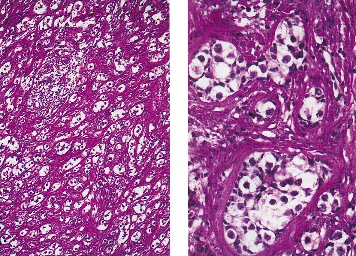 Pathology Outlines Unclassified Sex Cord Stromal Tumors 8869