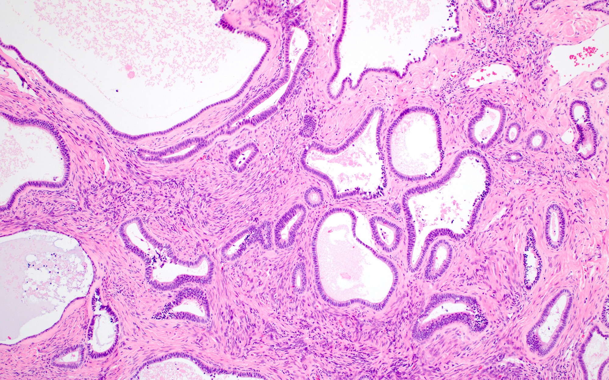 Pathology Outlines Endometrioid Cystadenoma And Adenofibroma