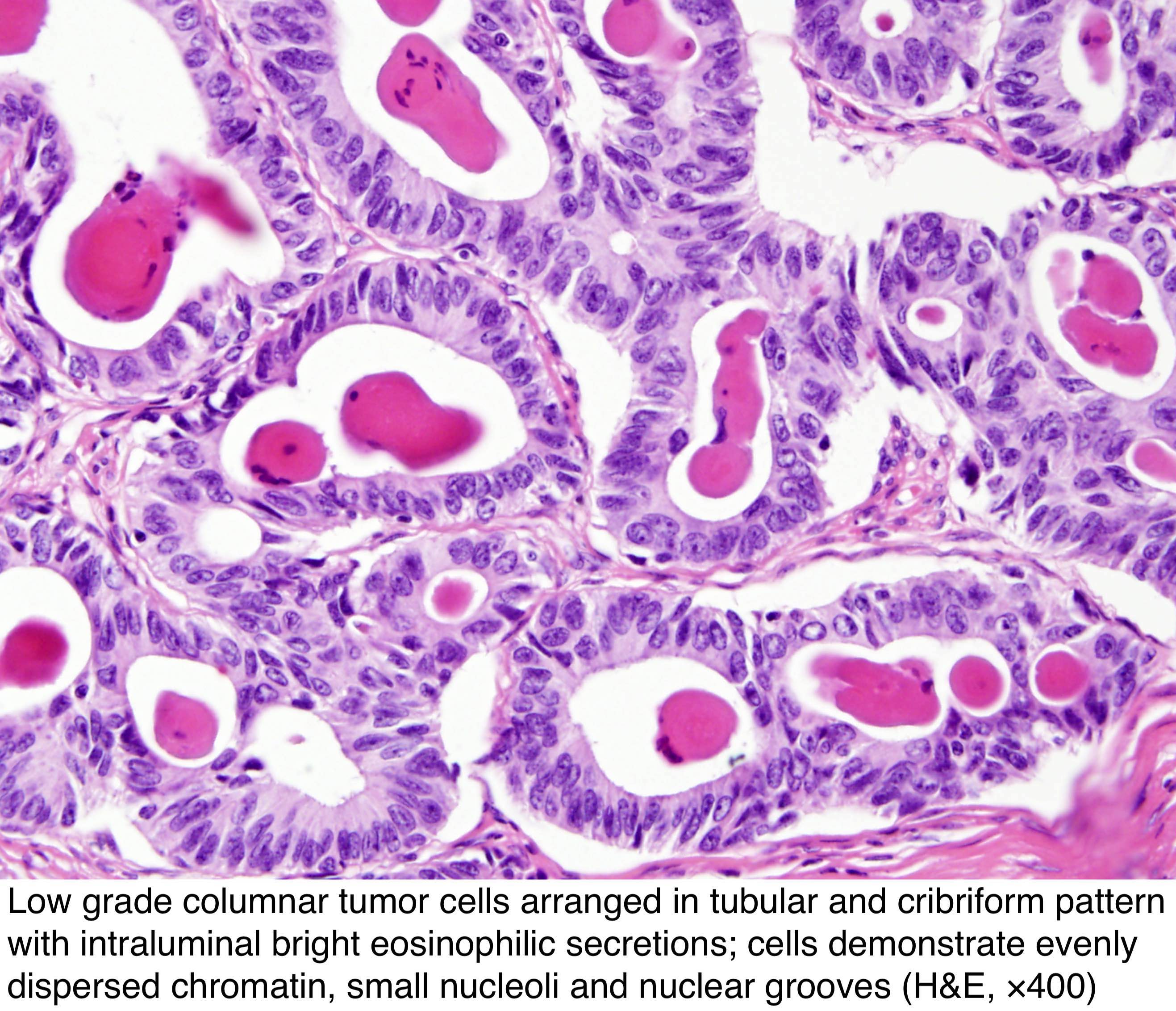Pathology Outlines - Female adnexal tumor of probable Wolffian origin ...