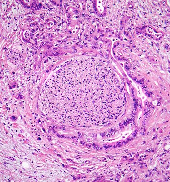 Pathology Outlines - Ductal adenocarcinoma, NOS