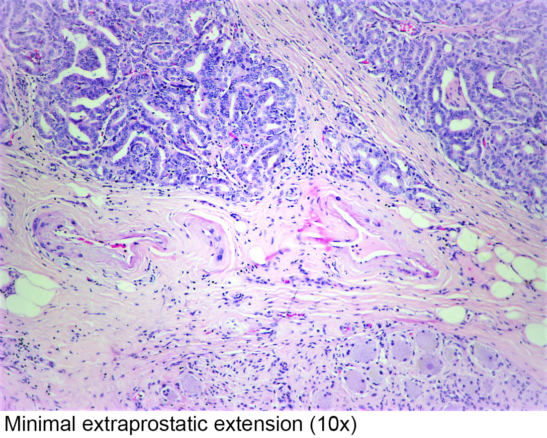 Prostatic acinar adenocarcinoma pathology outlines - Gleason 54 9 prostate cancer