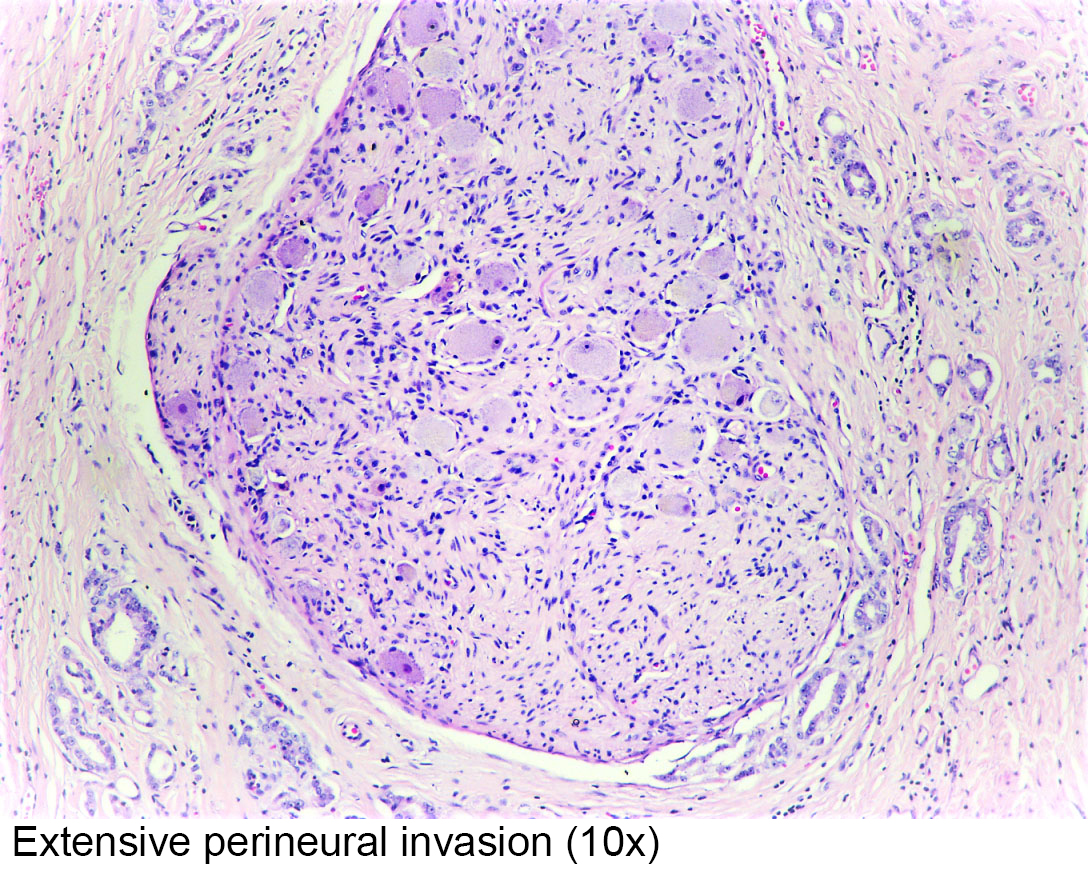 mucinous adenocarcinoma prostate pathology outlines gradsky și prostatita