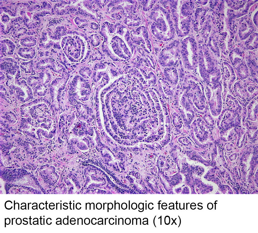 mucinous adenocarcinoma prostate pathology outlines)
