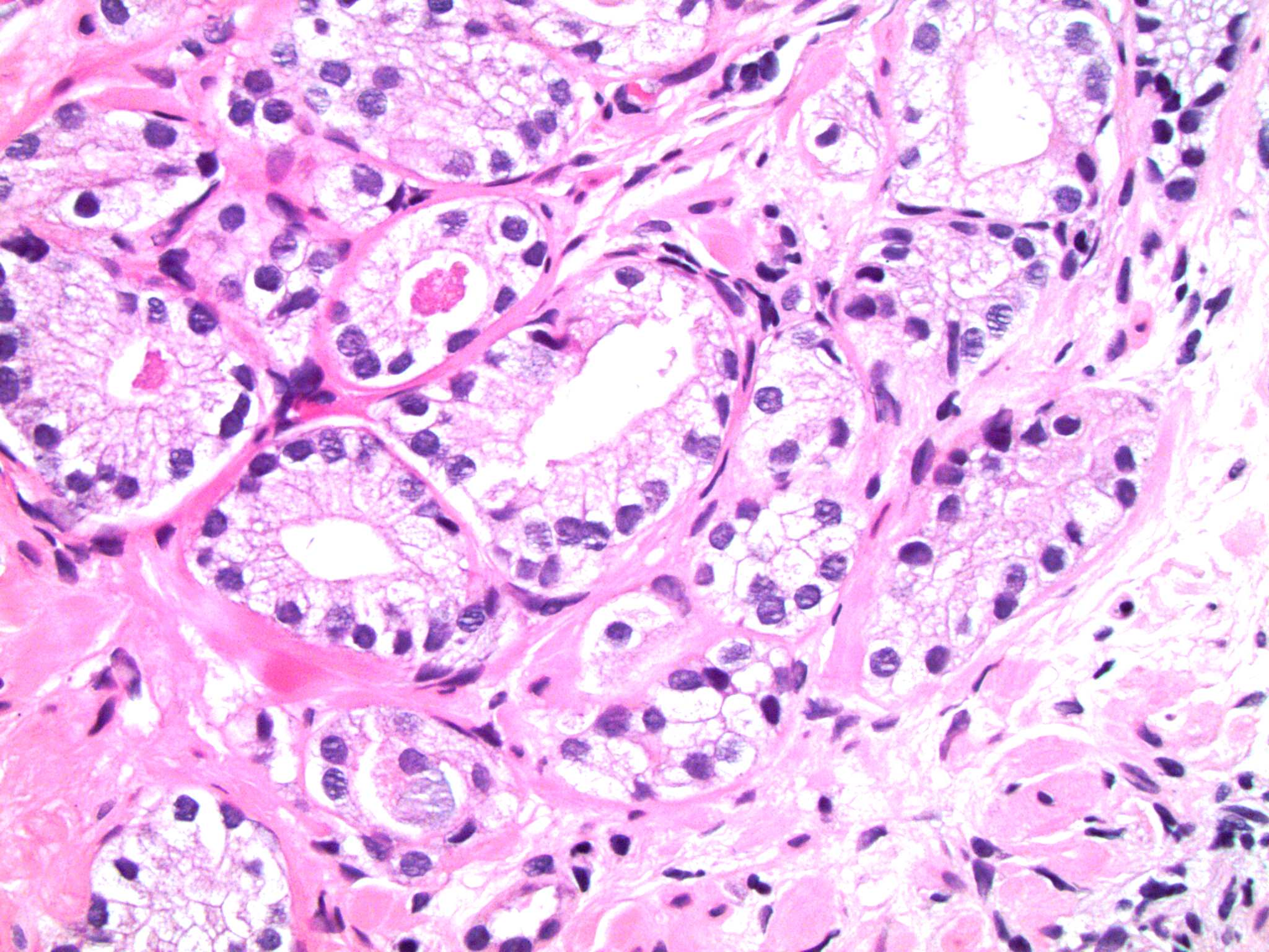 post atrophic hyperplasia prostate pathology cu ce se elimina nisipul de la rinichi