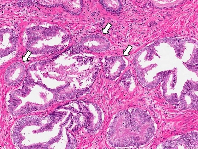 Pathology Outlines - HGPIN with adjacent atypical glands