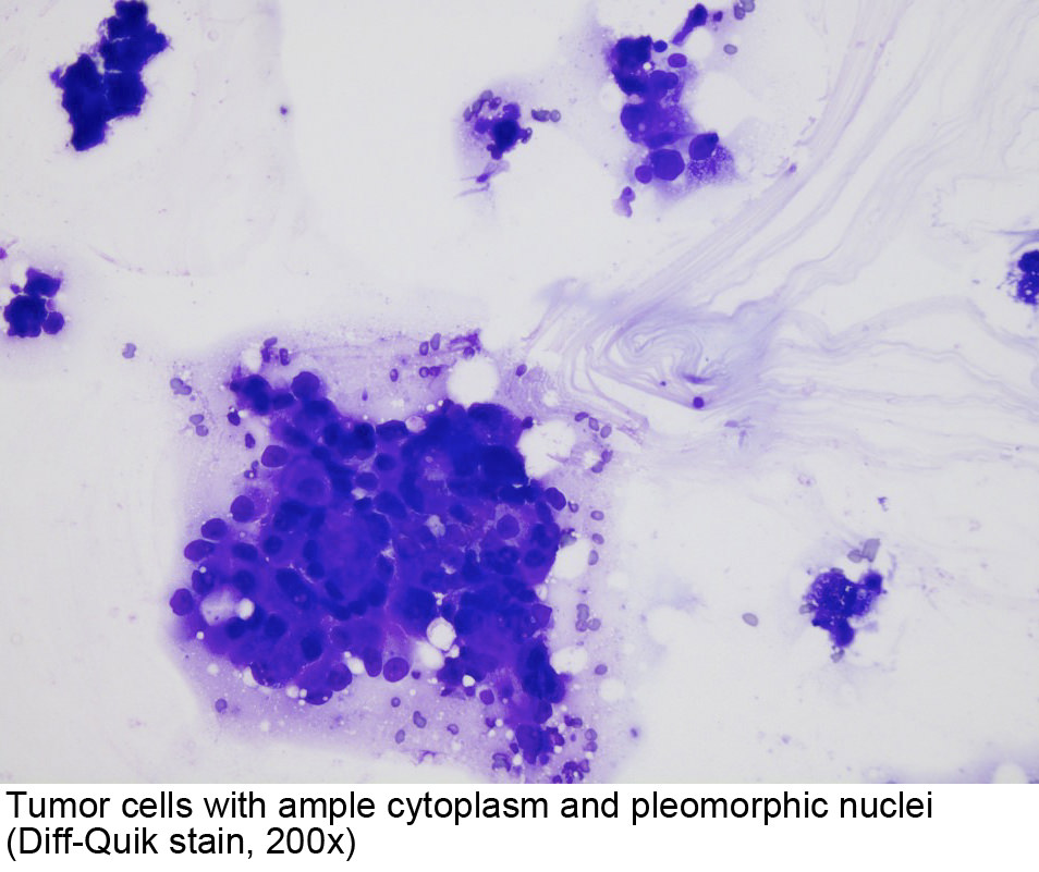 Pathology Outlines - Salivary duct carcinoma