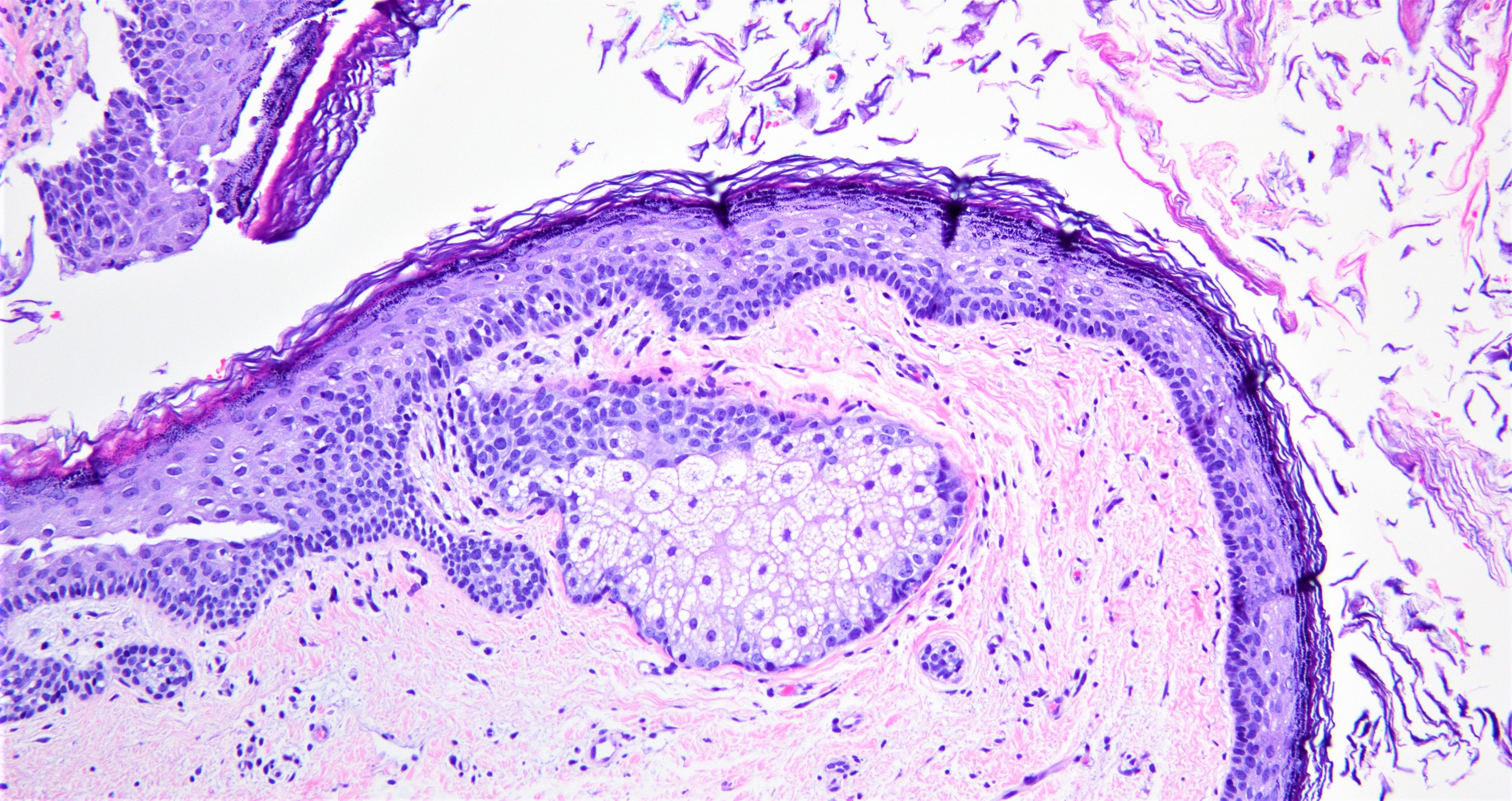 Pathology Of Dermoid Cyst Of The Pancreas Dermoid Cyst | SexiezPicz Web ...