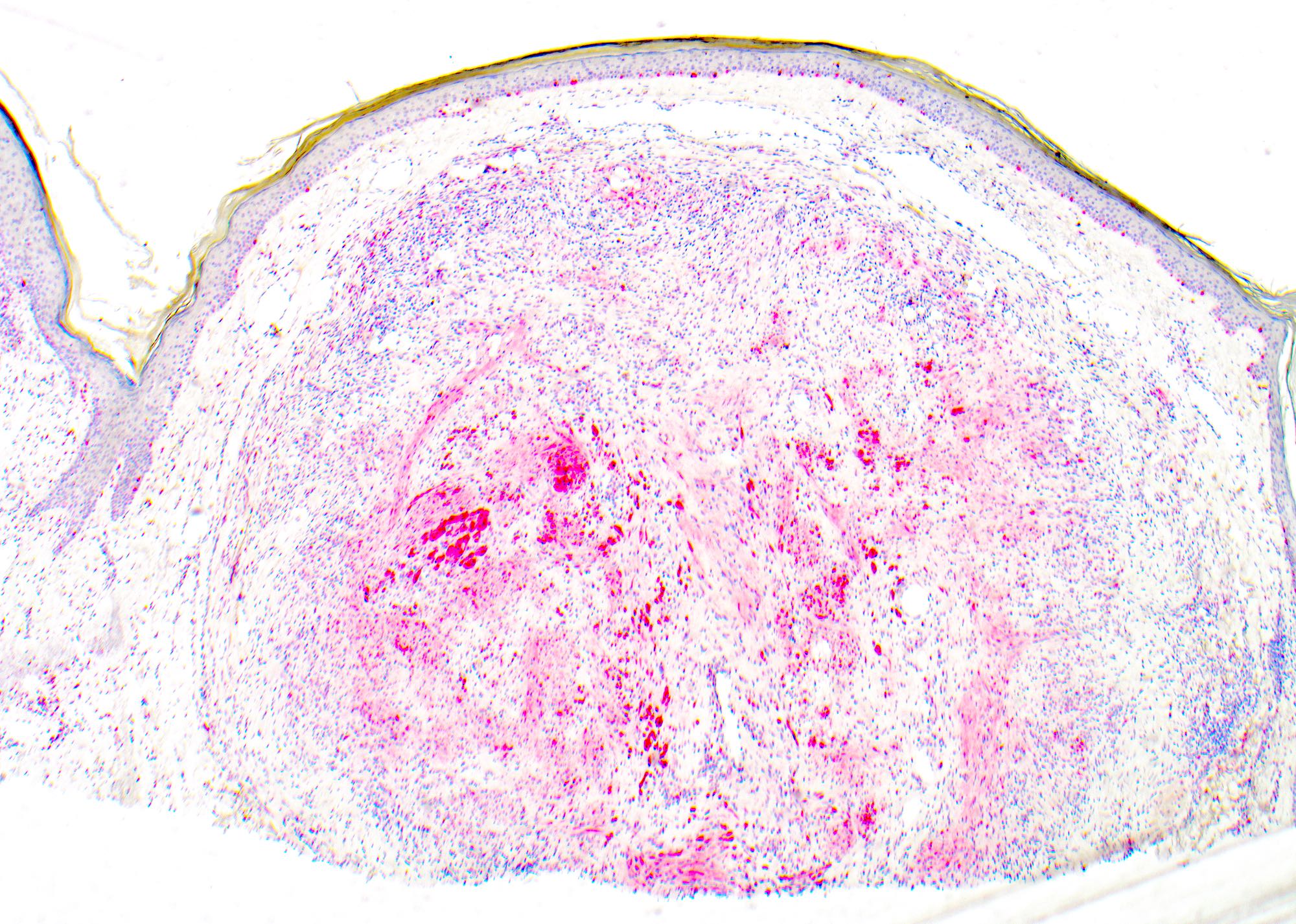 Pathology Outlines - Cutaneous neurocristic hamartoma