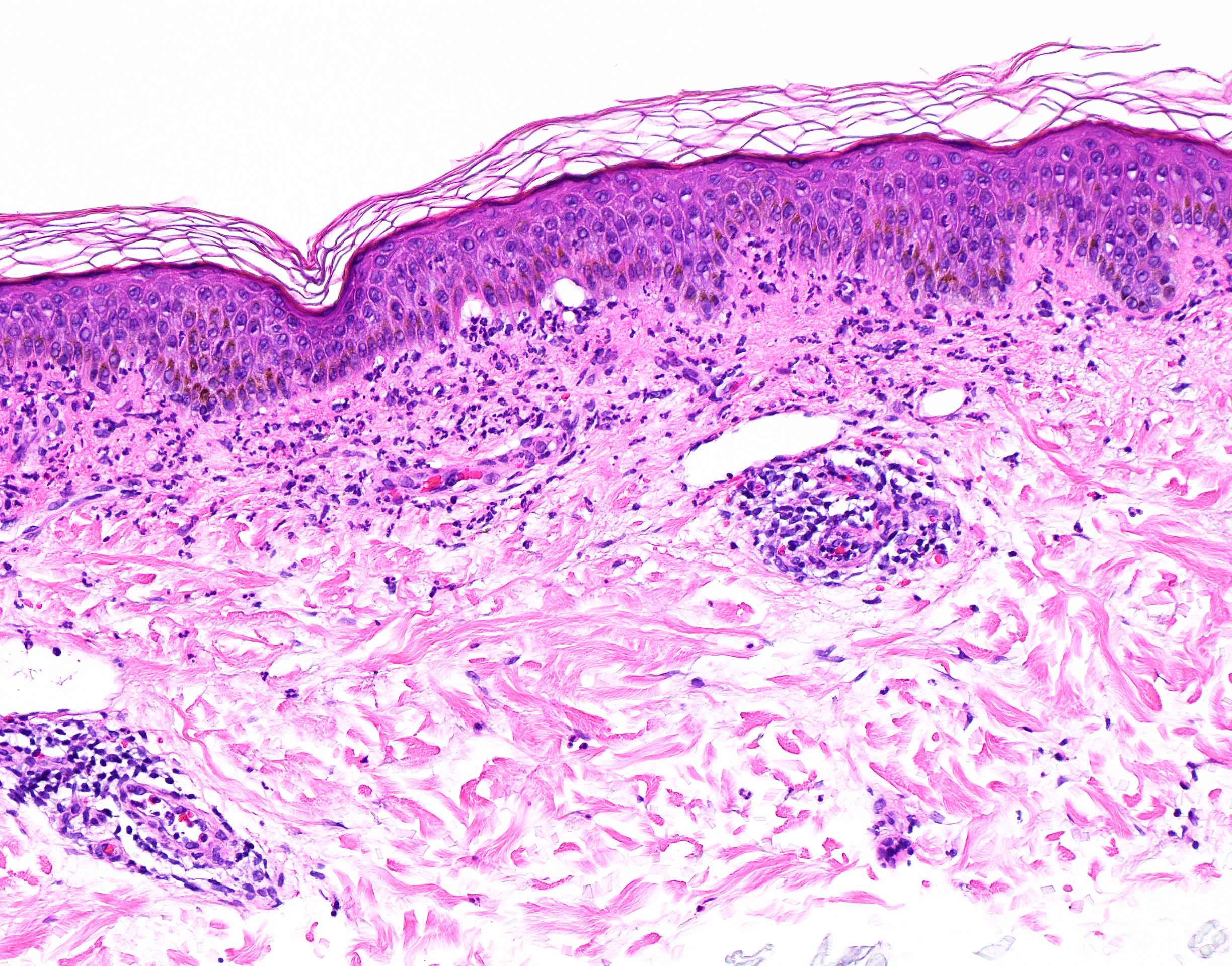 Dermatitis Herpetiformis Histology