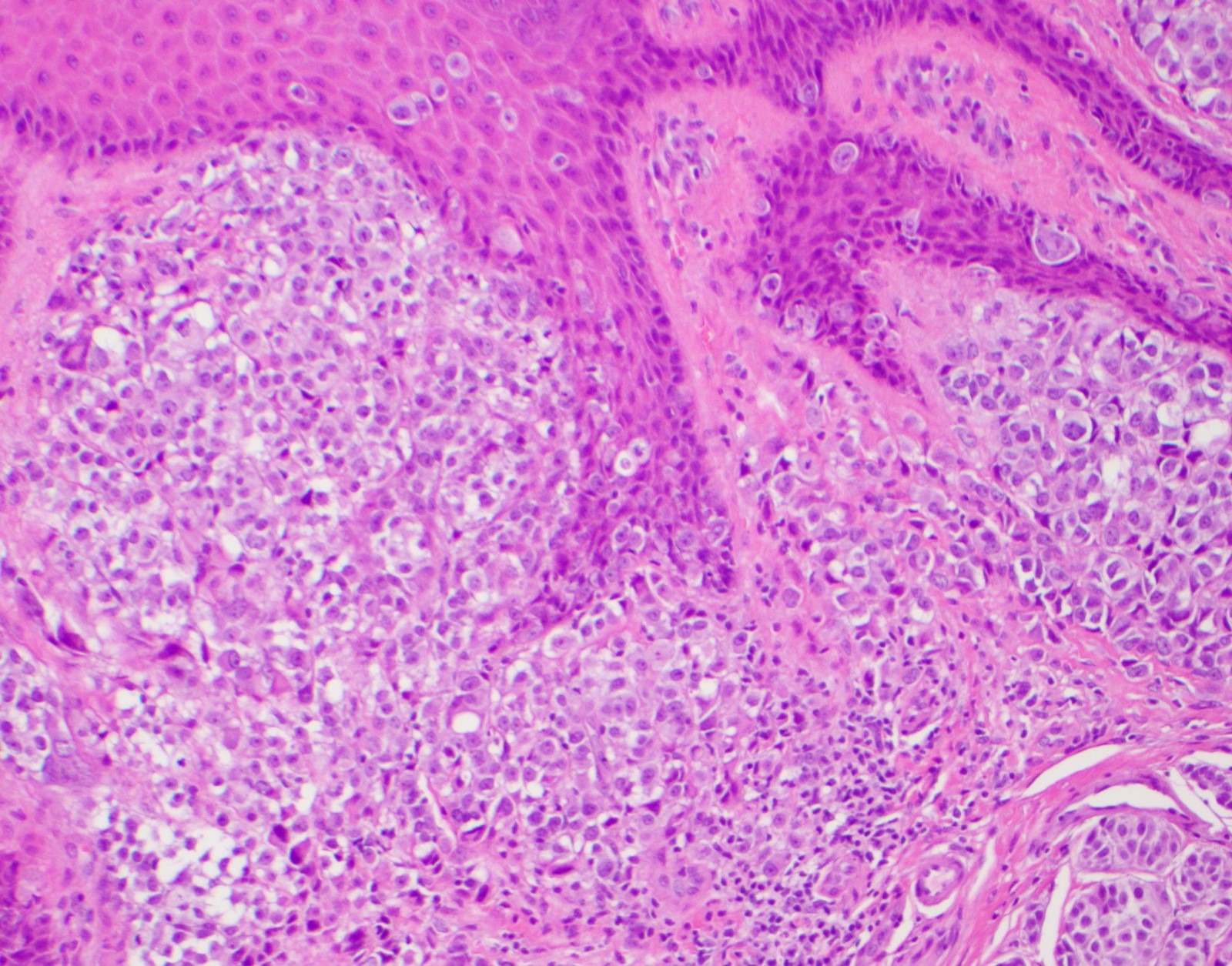 Pathology Outlines - Acral melanoma