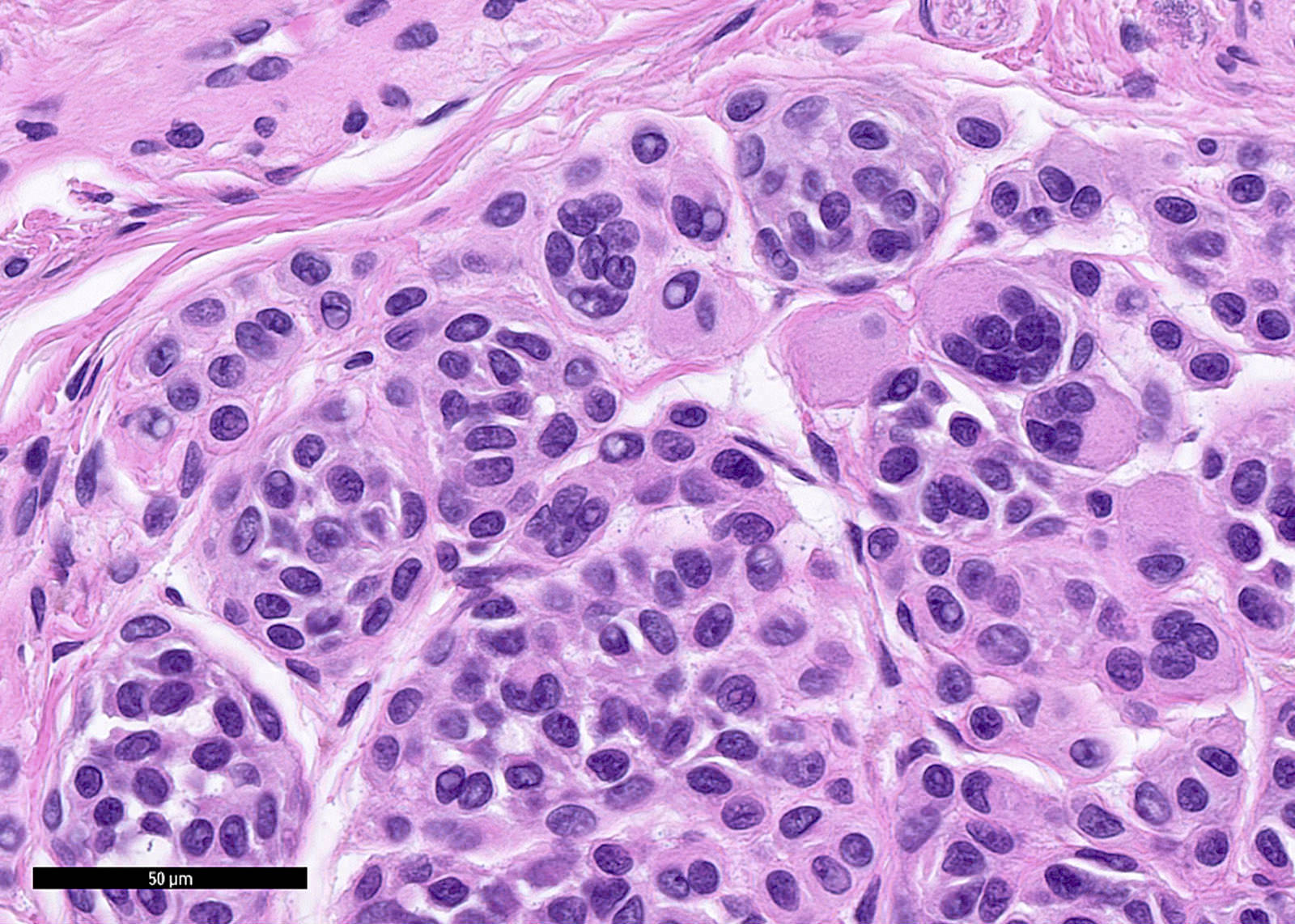 junctional melanocytic nevus