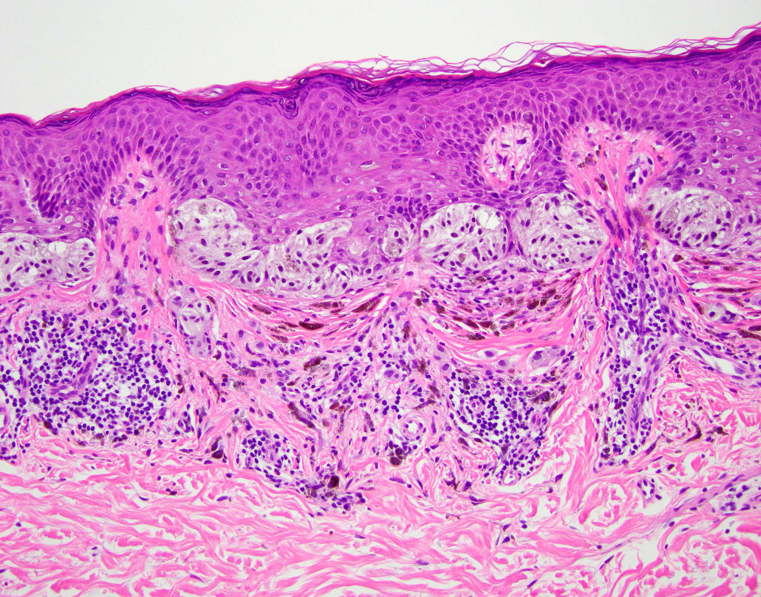 Pathology Outlines - Dysplastic nevus