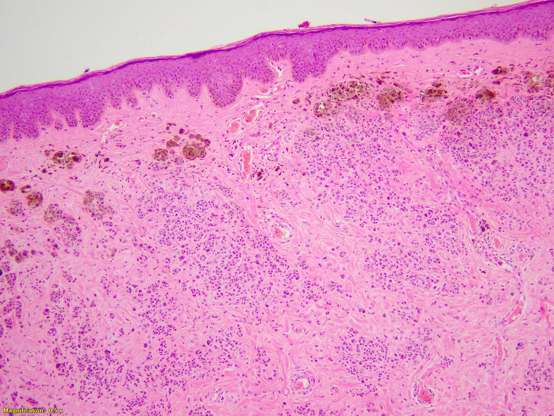 Dermal melanocytic proliferation