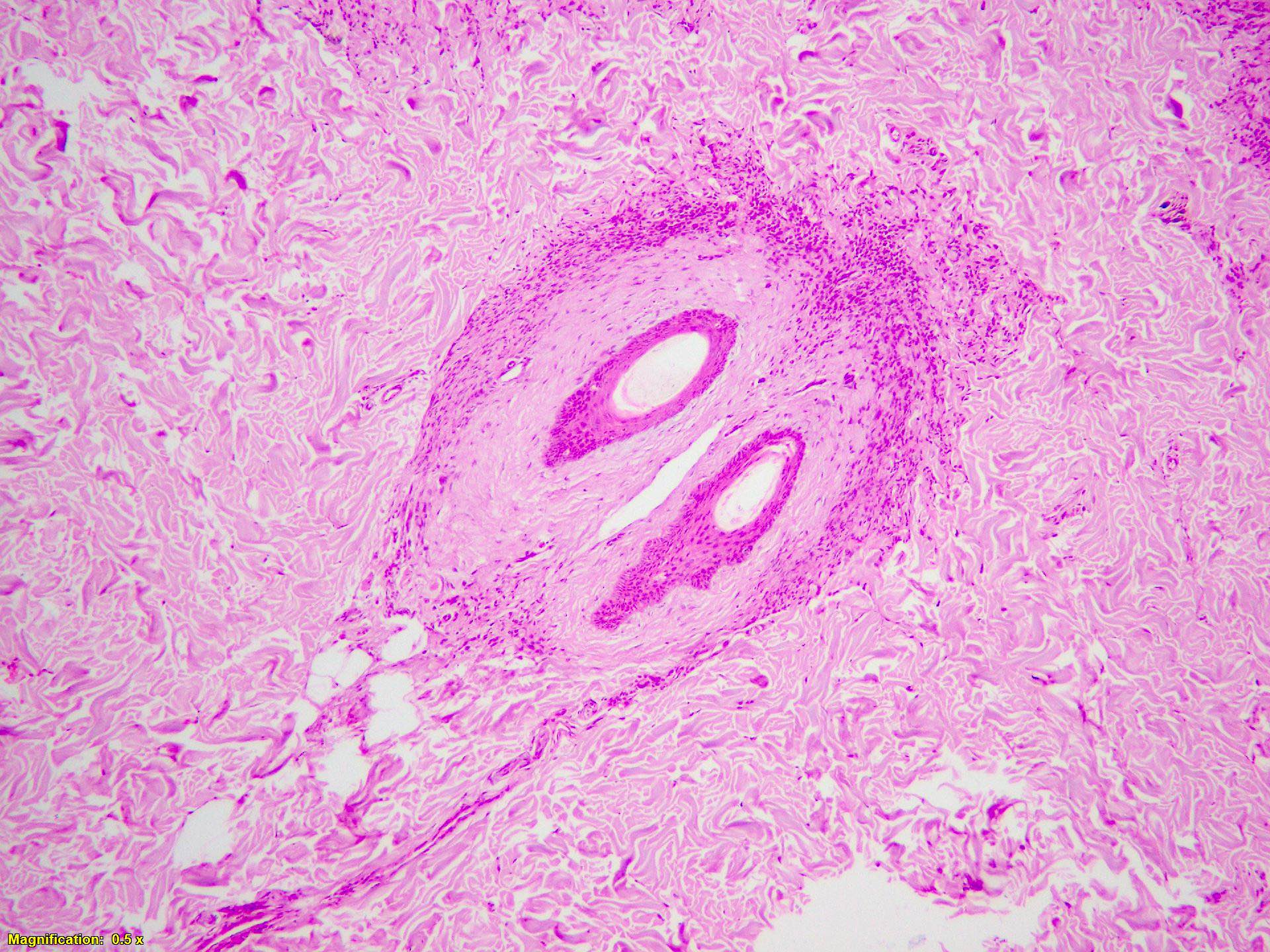 Melanocytes centered on pilosebaceous units
