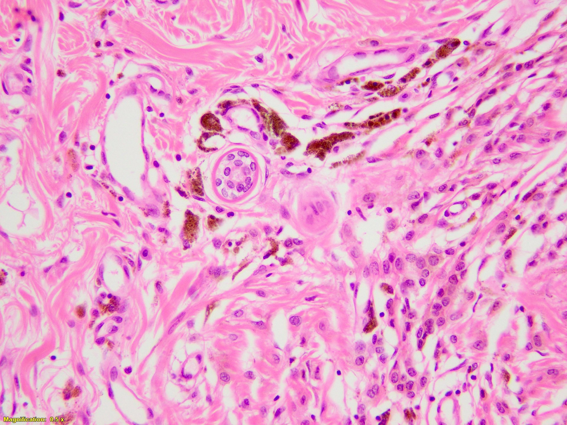 Melanocytes centered on eccrine duct