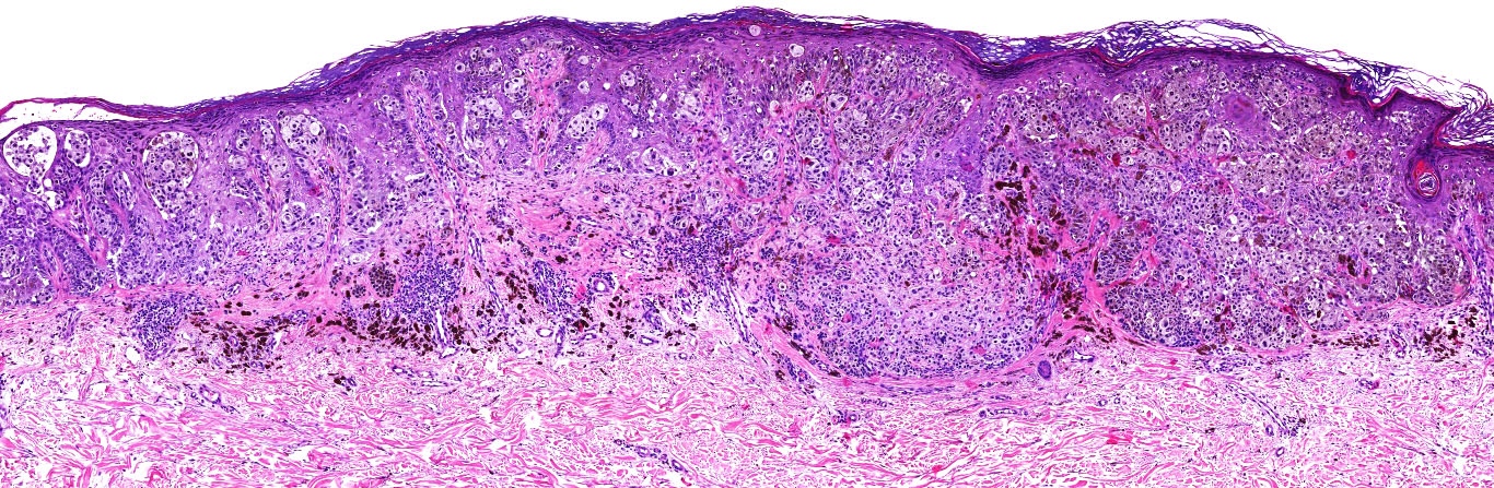 invasive melanoma histology