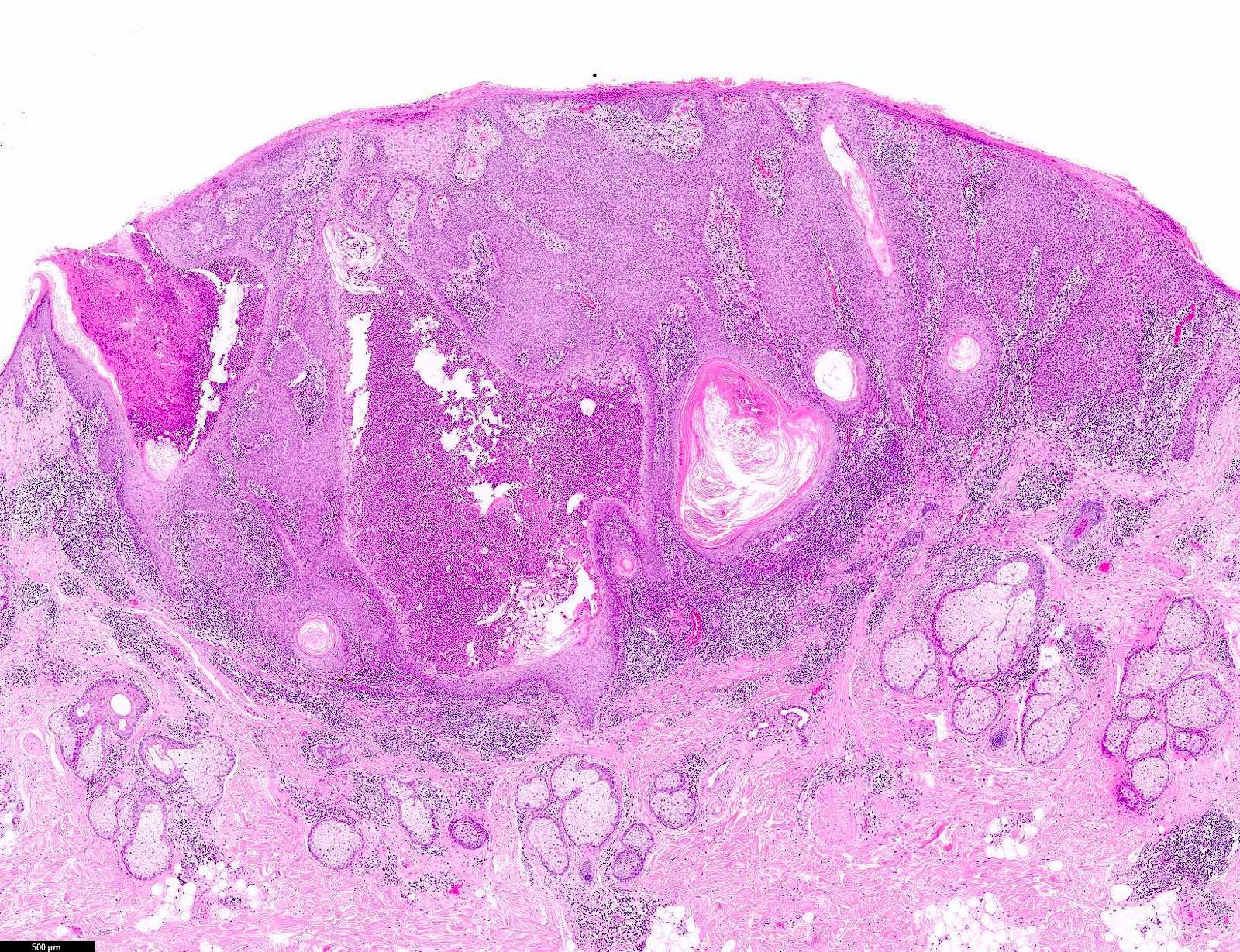 Seborrheic Keratosis Histology Seborrheic Keratosis Mnemonics Pathology ...