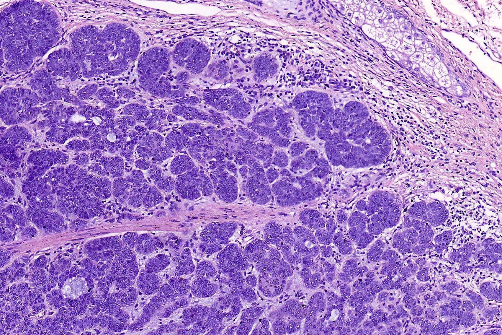Aggregate More Than 113 Basal Cell Carcinoma Histology Drawing