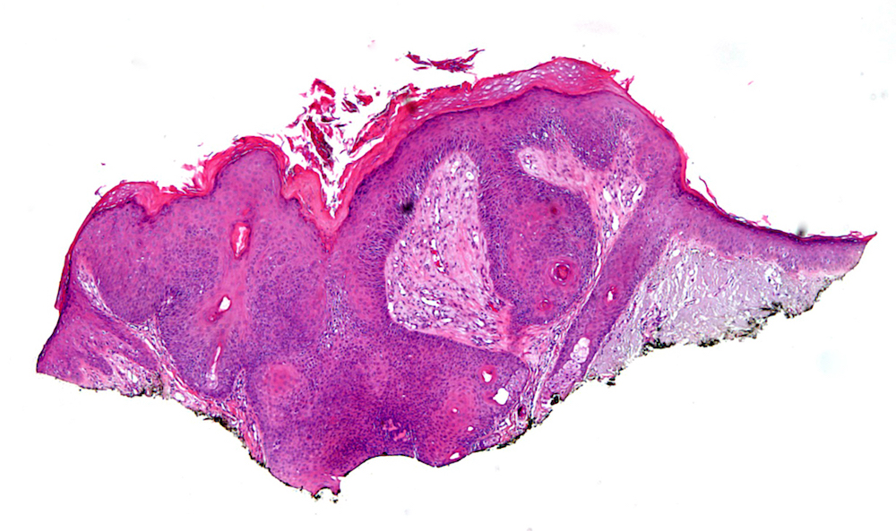 Pathology Outlines - Inverted follicular keratosis