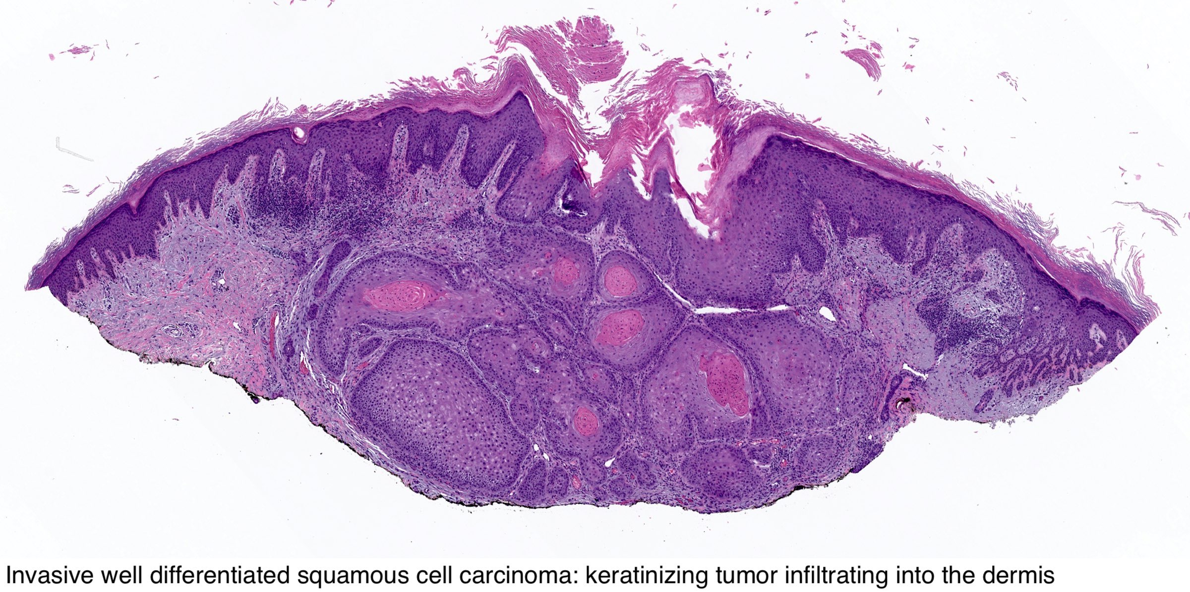 Squamous Cell Carcinoma Skin Histology