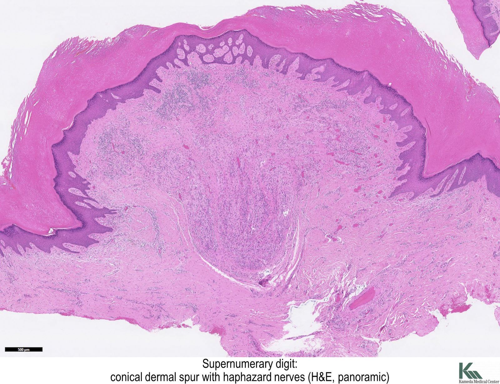 Pathology Outlines - Supernumerary Digit