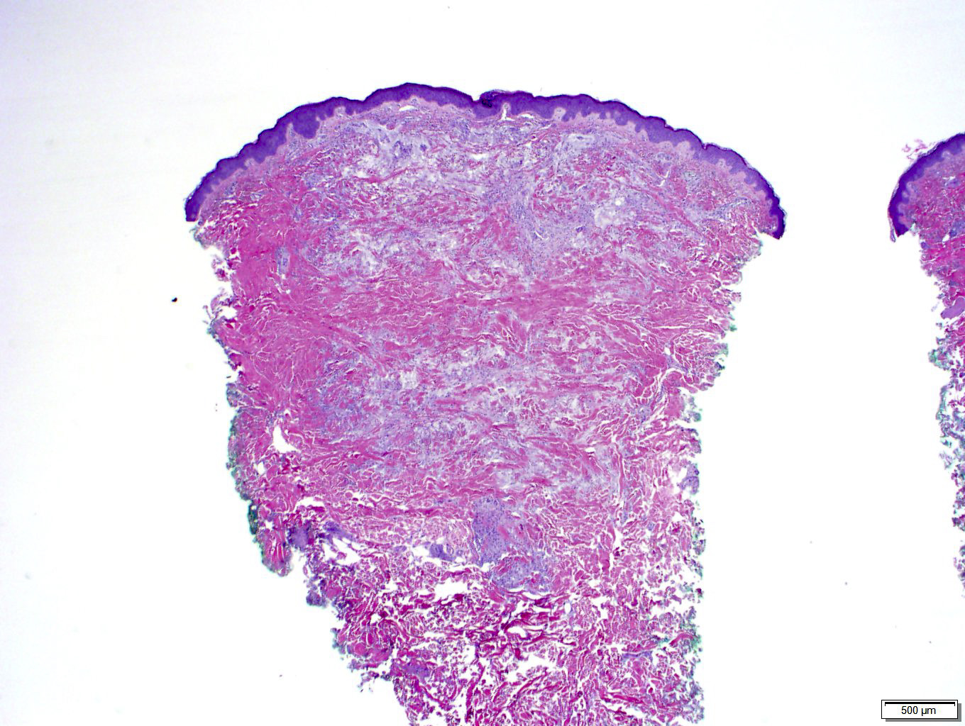 xanthelasma histology