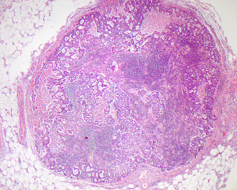 Pathology Outlines - Adenocarcinoma-small intestine