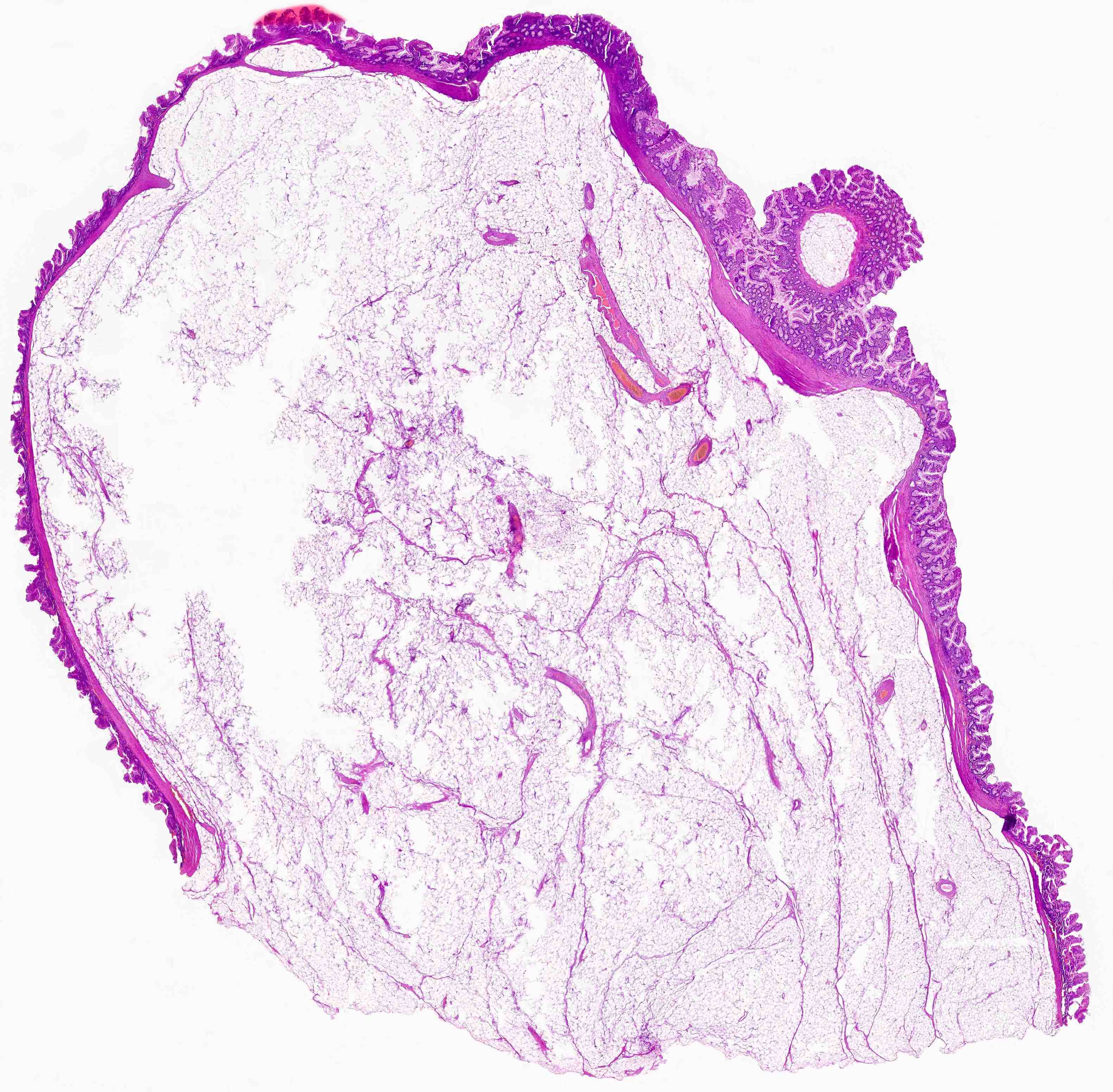 Pathology Outlines Lipoma