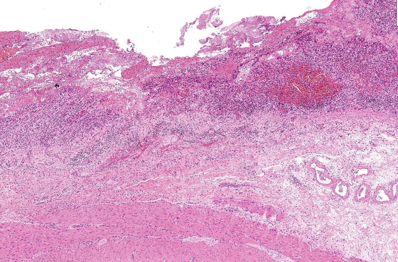 Pathology Outlines - Rejection