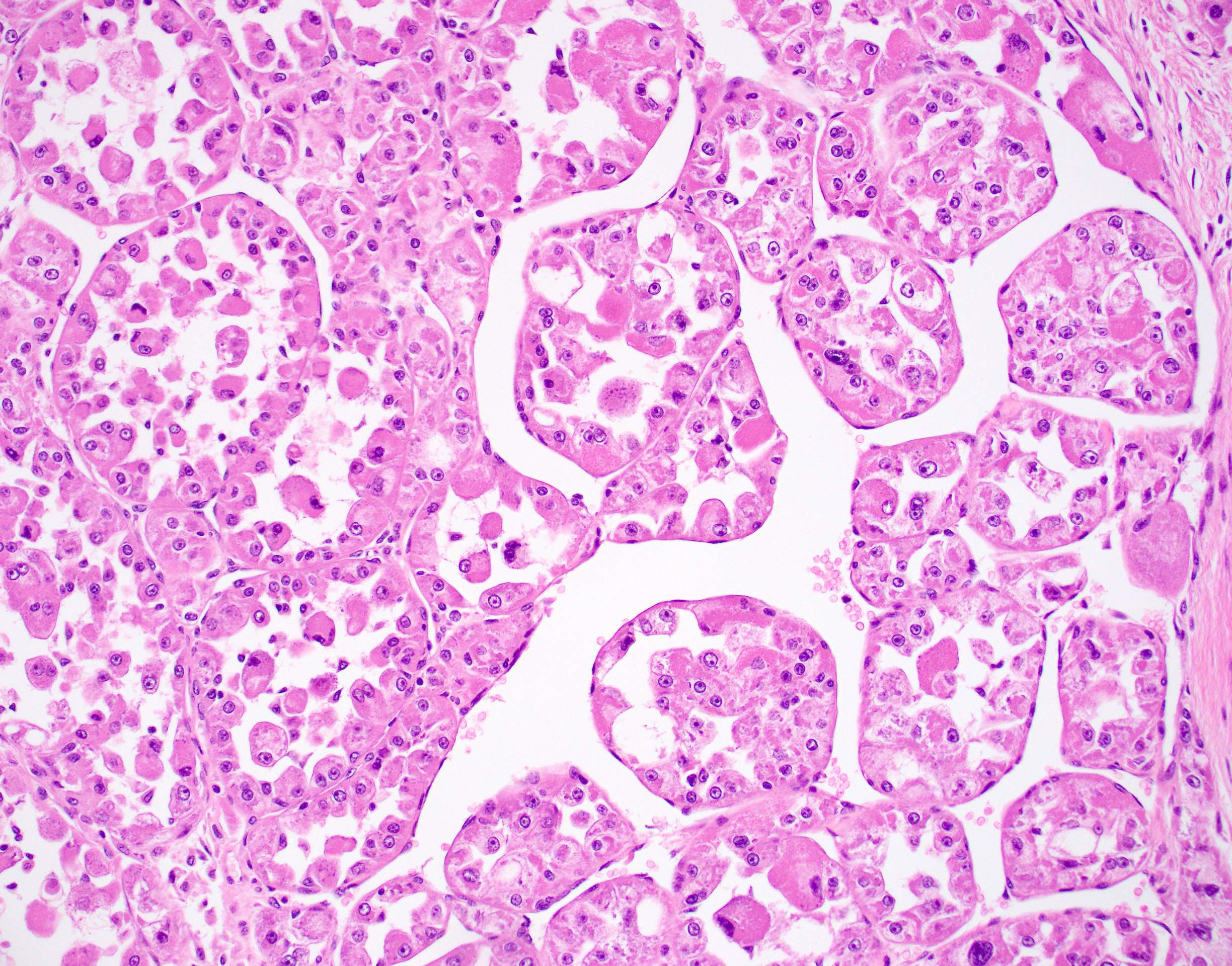 Pathology Outlines - Alveolar soft part sarcoma