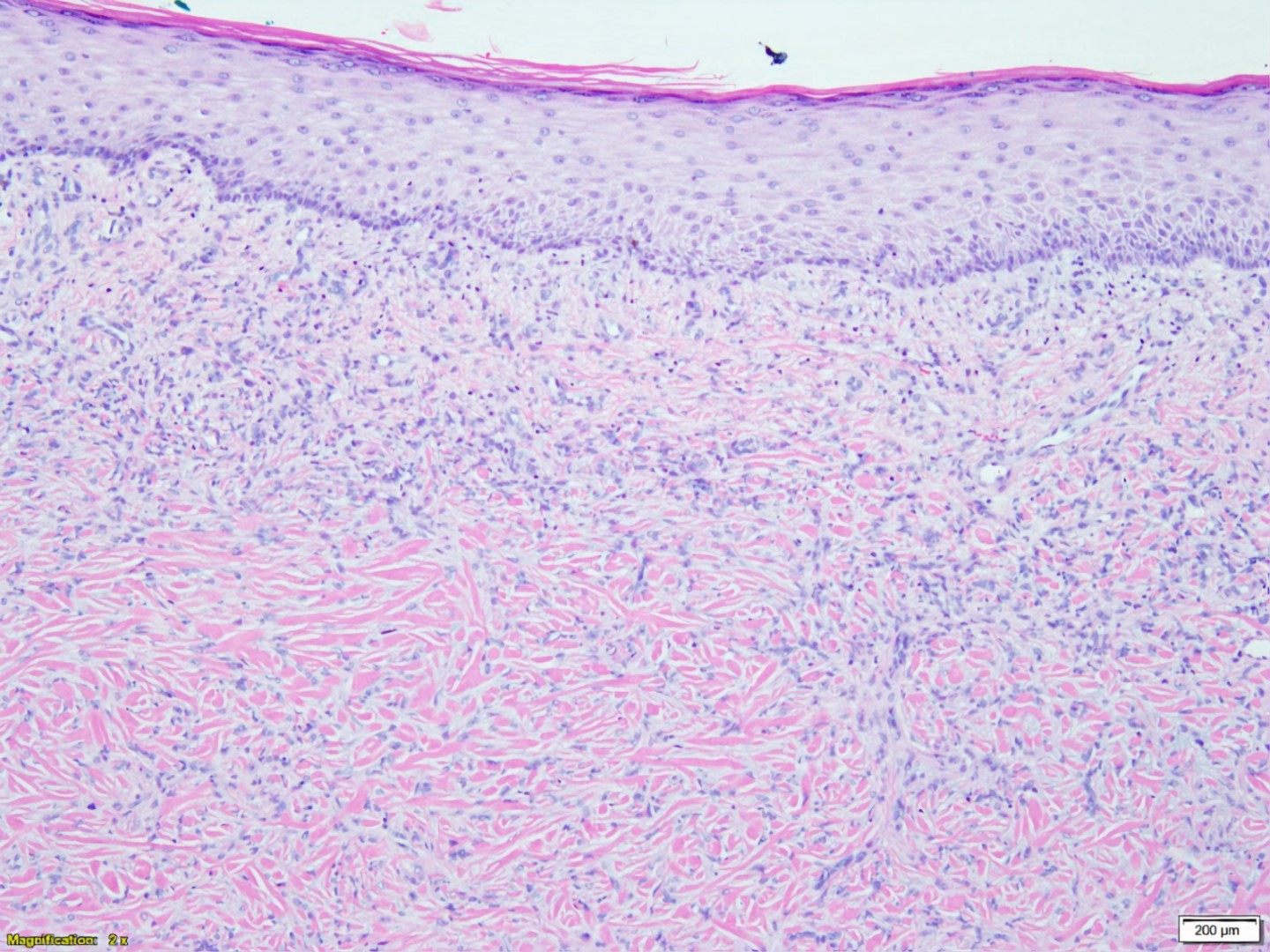 Pathology Outlines Dermatofibroma Cutaneous Fibrous Histiocytoma