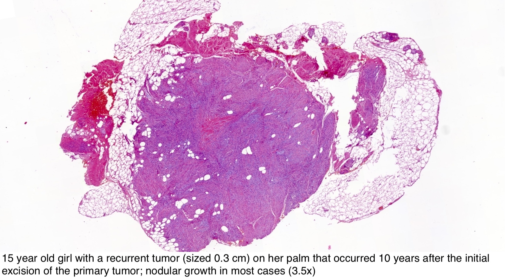 Pathology Outlines - EWSR1-SMAD3 rearranged