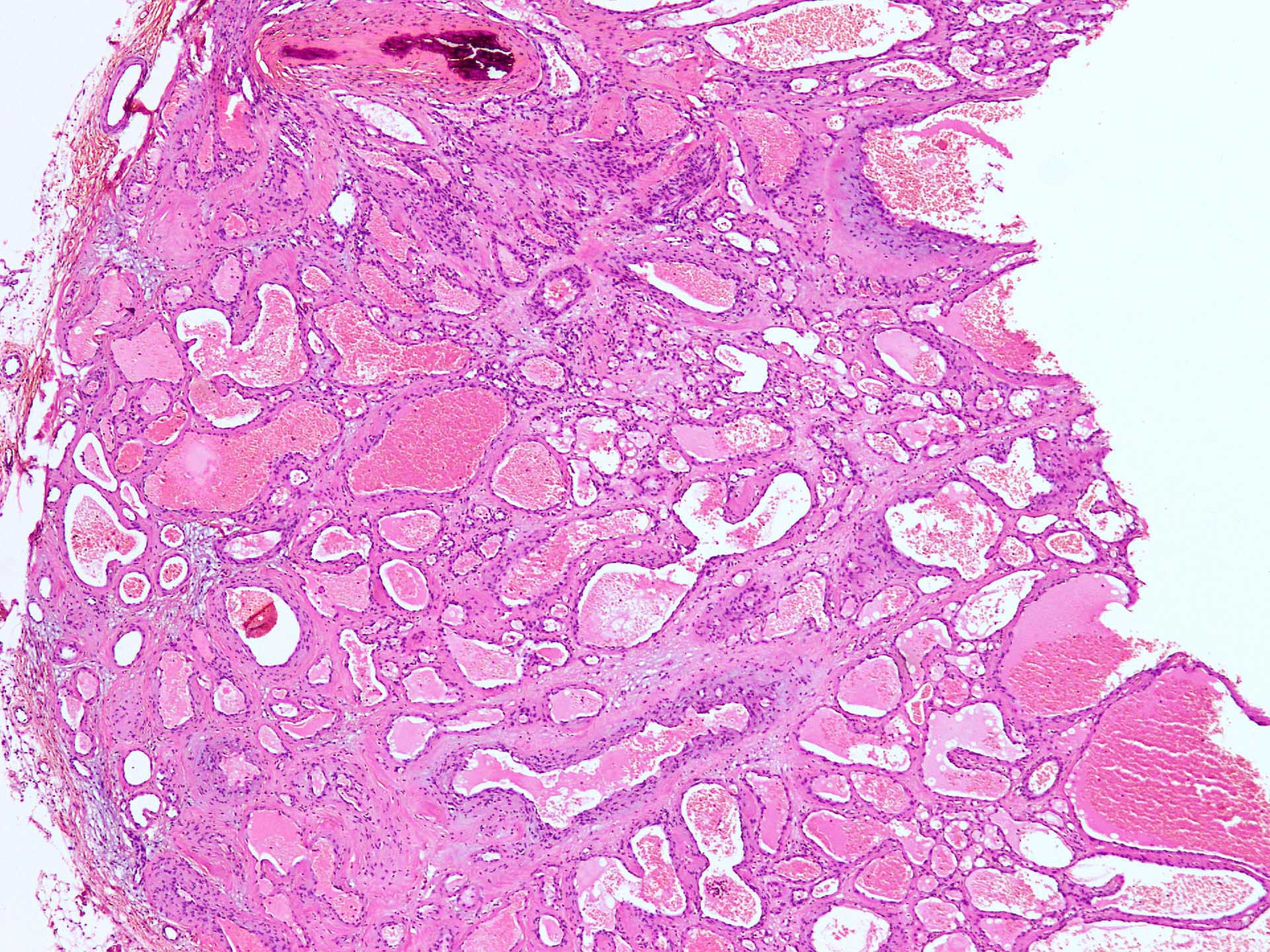 Capillary Hemangioma Histology