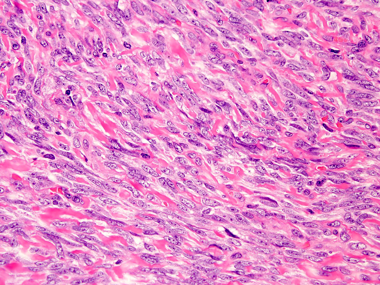 Synovial Sarcoma Histology