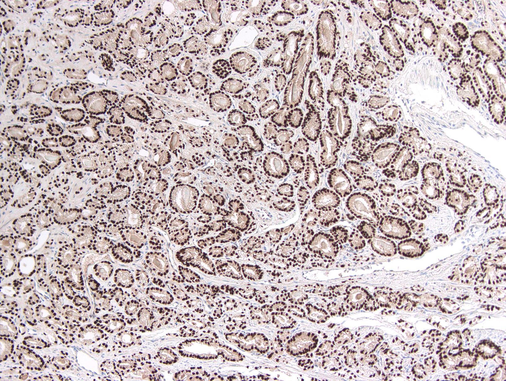 mucinous adenocarcinoma prostate pathology outlines