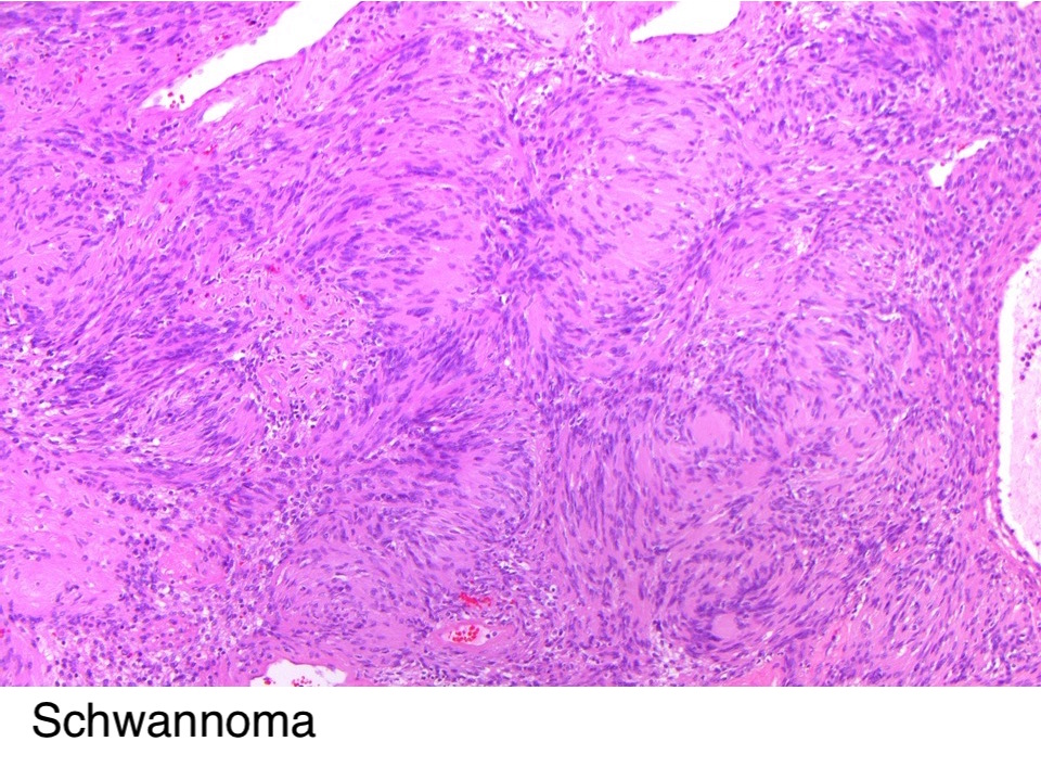 Pathology Outlines H3k27me3