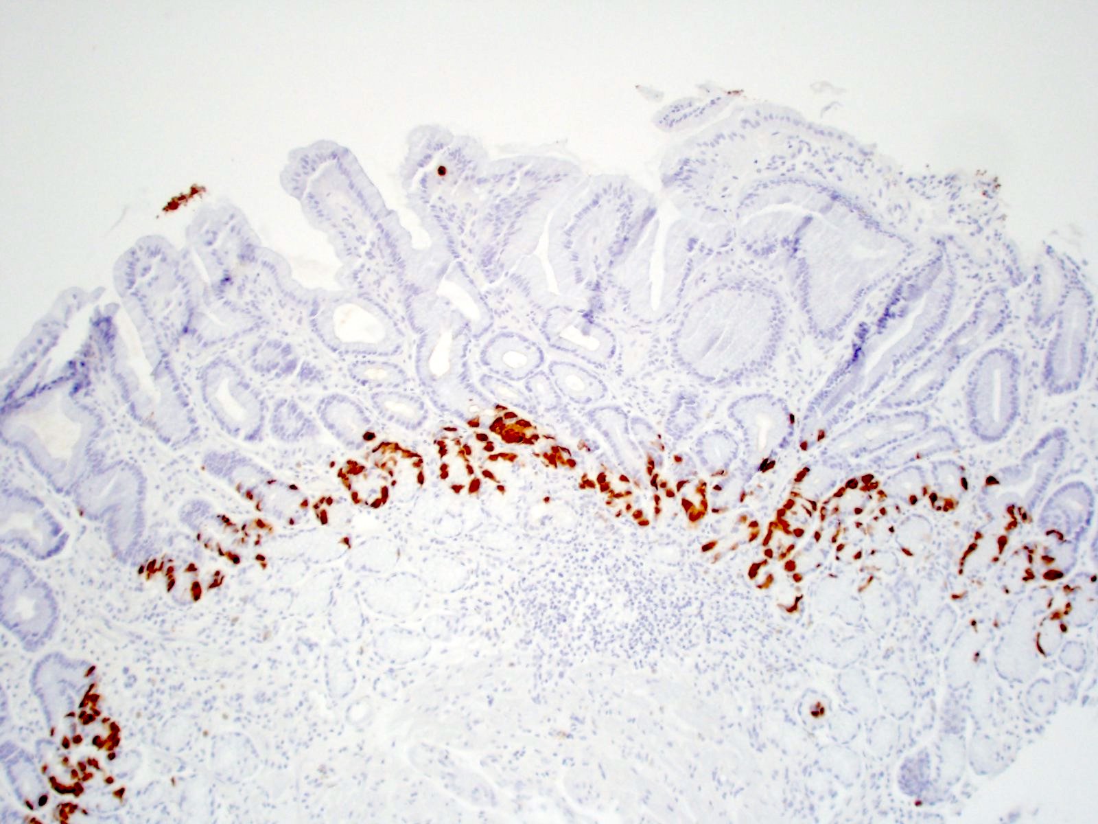 gastritis antrum autoimmune pathology outlines stain gastrin pathologyoutlines