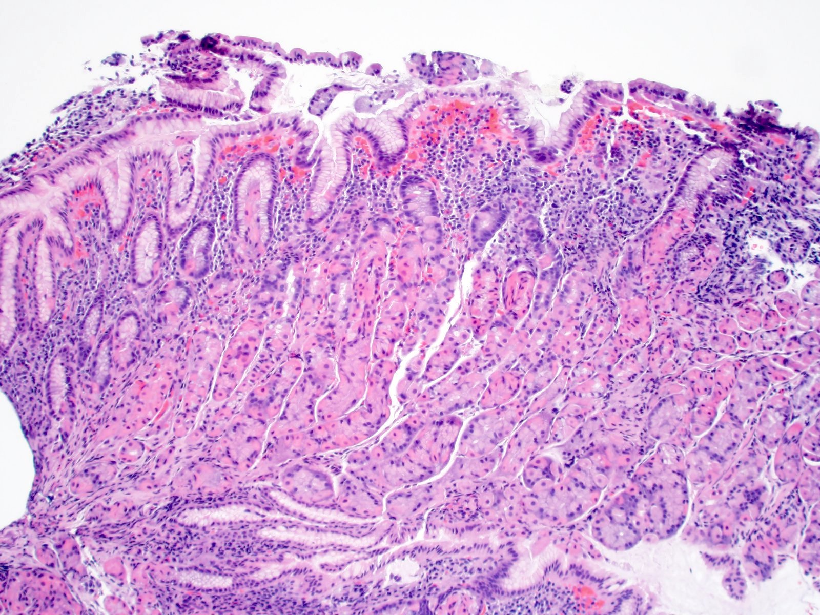 Pathology Outlines - Helicobacter pylori