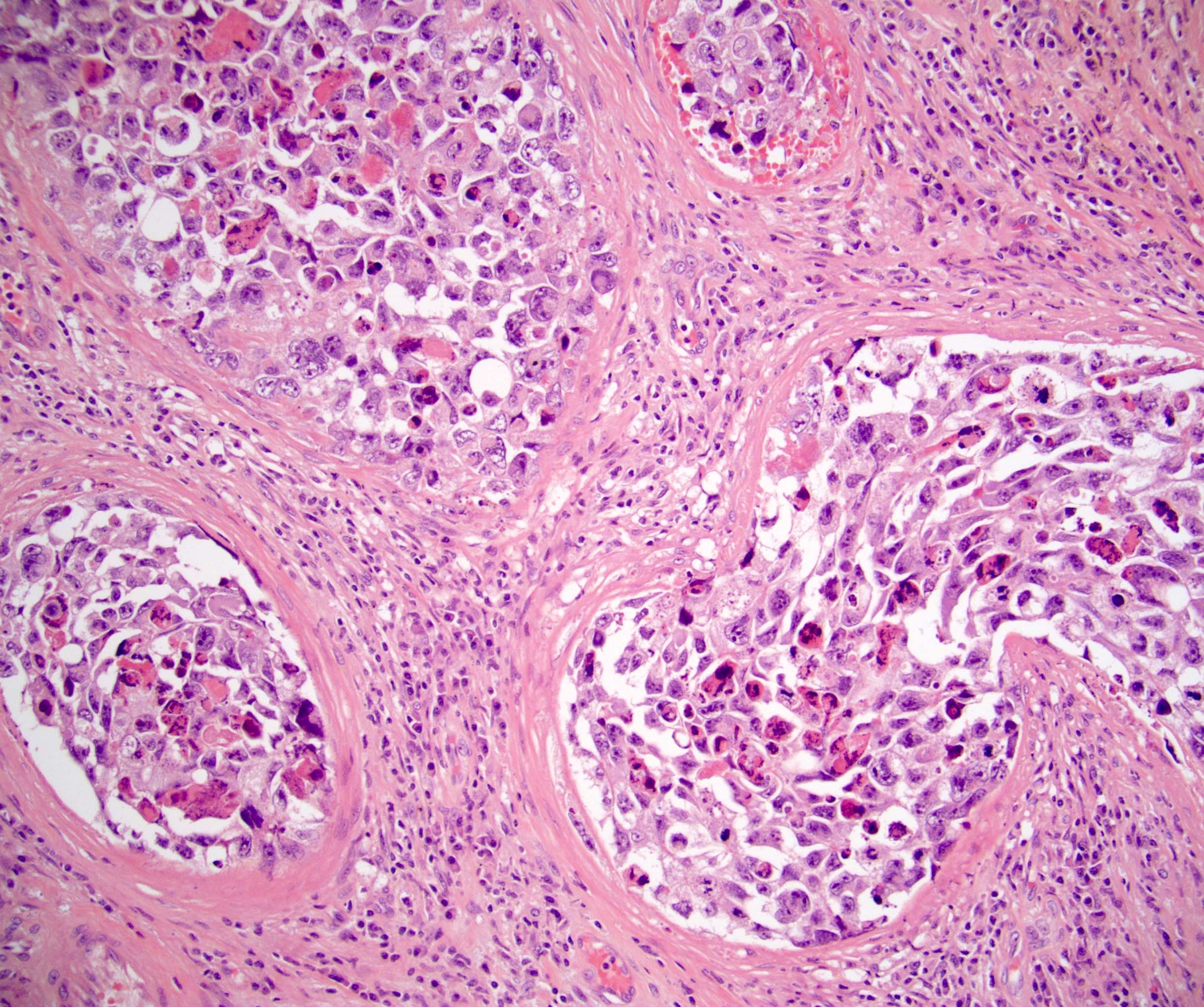 embryonal carcinoma cells